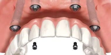 All-On-4 Implant