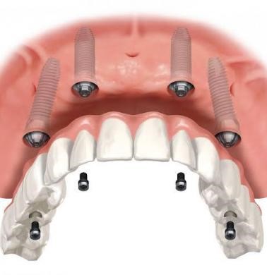 All-On-4 Implant